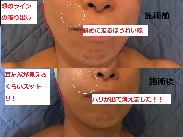 ◎コラーゲンマシン+光フェイシャル◎